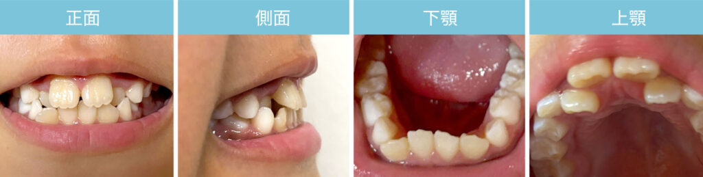 歯列矯正開始時の子どもの歯並び（マイオブレース使用前）