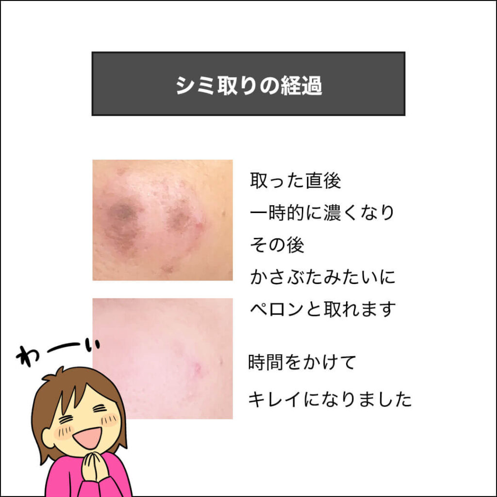 シミ取りをした経過の画像