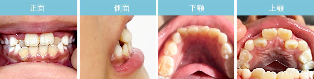 歯列矯正開始1ヶ月の子どもの歯並び（マイオブレース1ヶ月目記録）